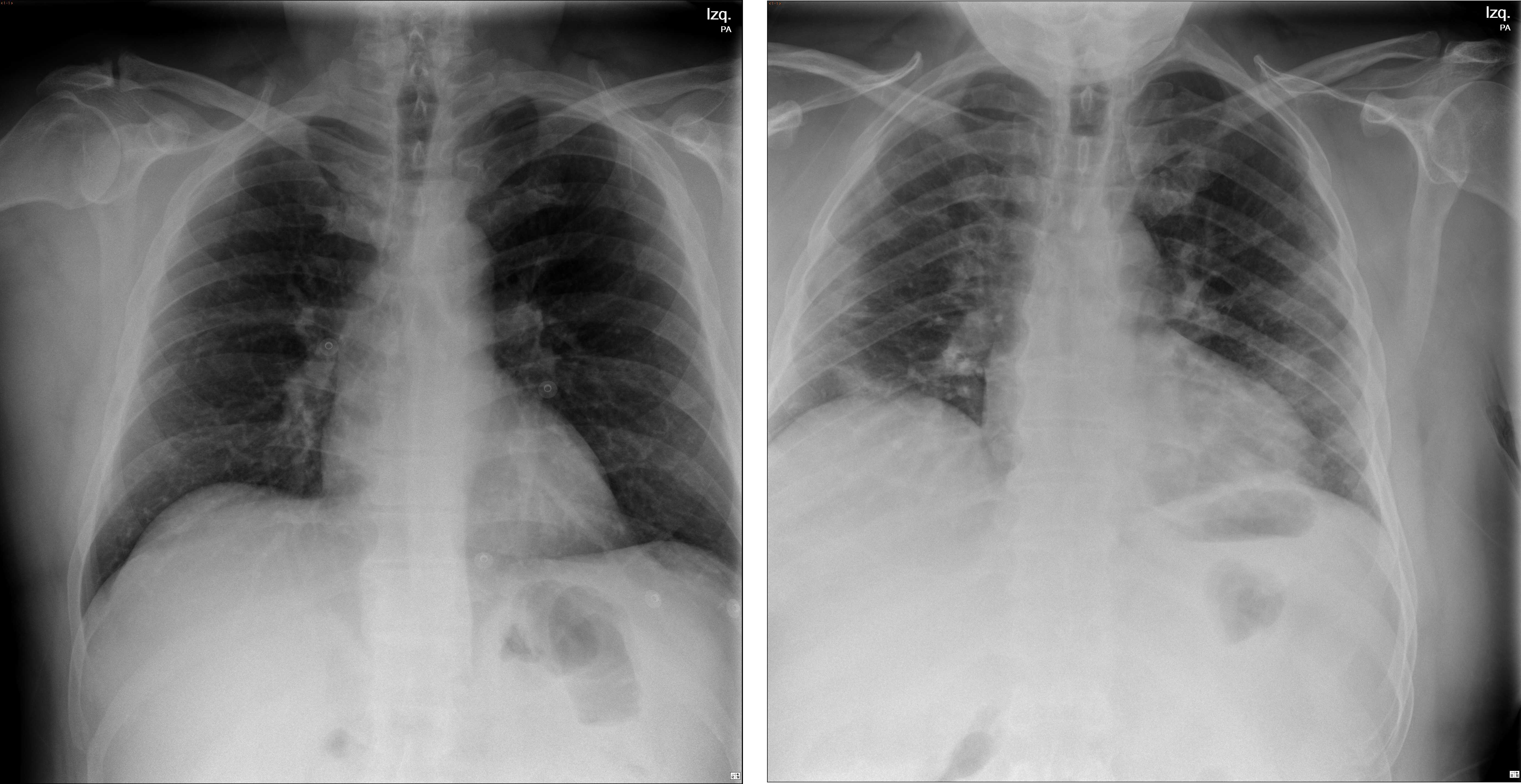 rayos x de pulmones no saludables