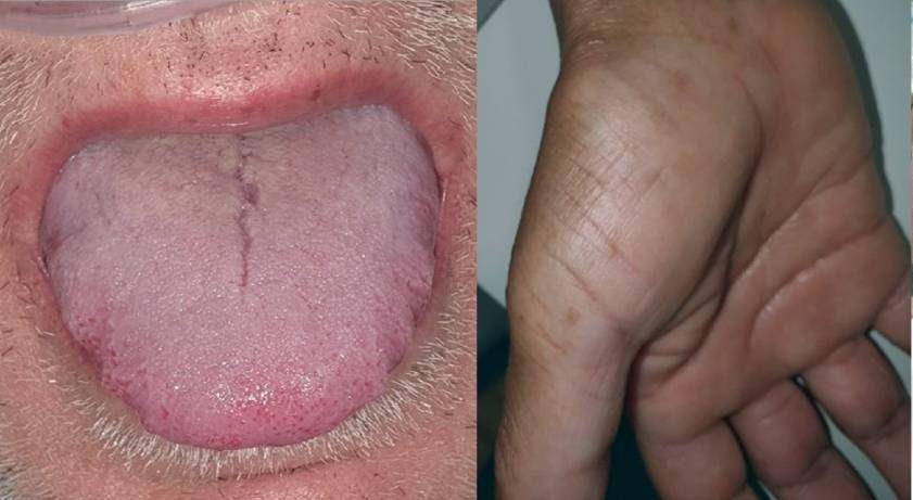 Alteraciones en la lengua y en palmas de las manos y pies como síntoma de - iDescubre